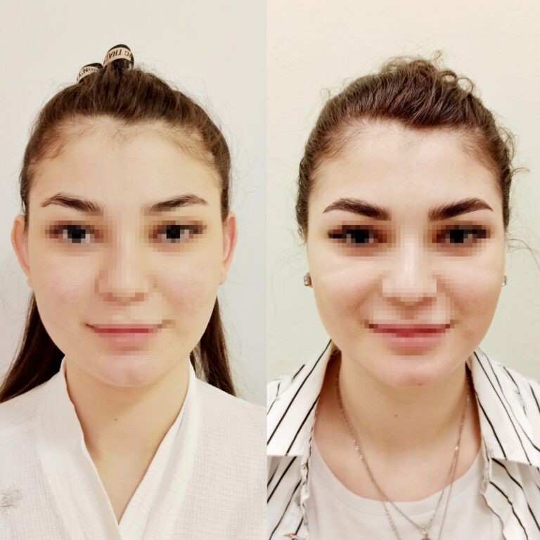 отопластика