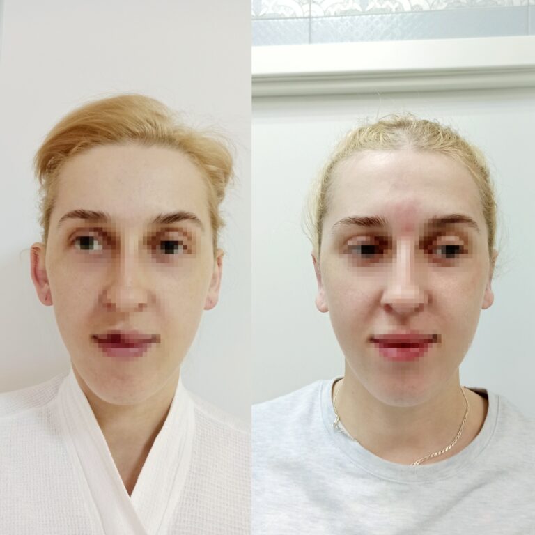 отопластика